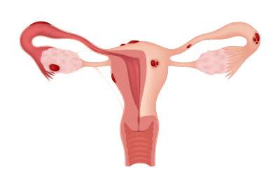 Premalignant Lesions of the Endometrium