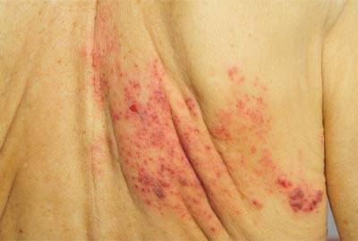 Postherpetic neuralgia 
