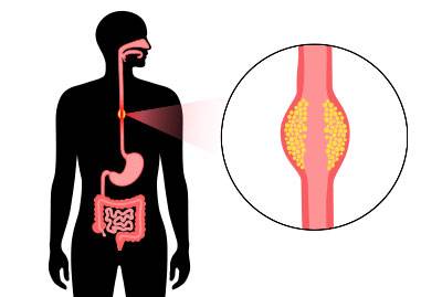 Esophageal cancer 