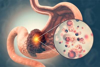 Gastric cancer 