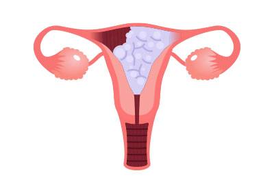 Gestational Trophoblastic Tumor 
