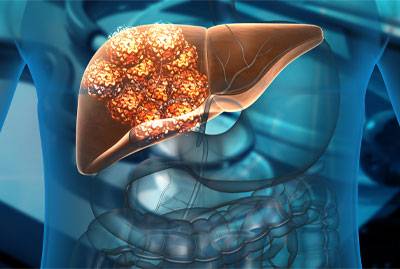 Hepatocellular carcinoma 