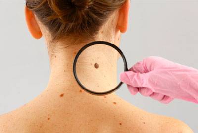 اعراض و اسباب ساركوما كابوسي  (Kaposi Sarcoma) 
