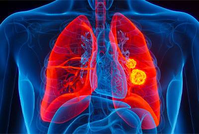 Non-Small-Cell Lung Cancer (NSCLC) 